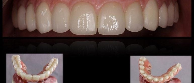 PERFECT SMILE VENEERS – ЗУБНЫЕ ВИНИРЫ ДЛЯ СКРЫТИЯ ЛЮБЫХ ДЕФЕКТОВ